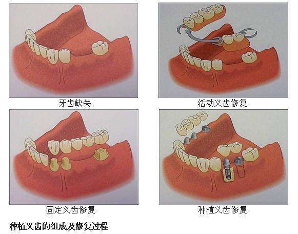 哈爾濱牙齒種植